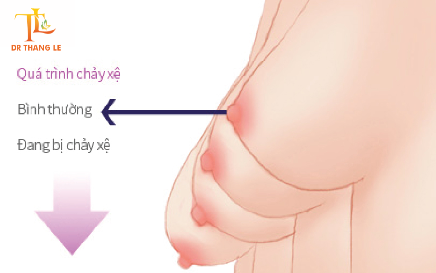 Một trong những lí do ngực chảy xệ là do tuổi tác