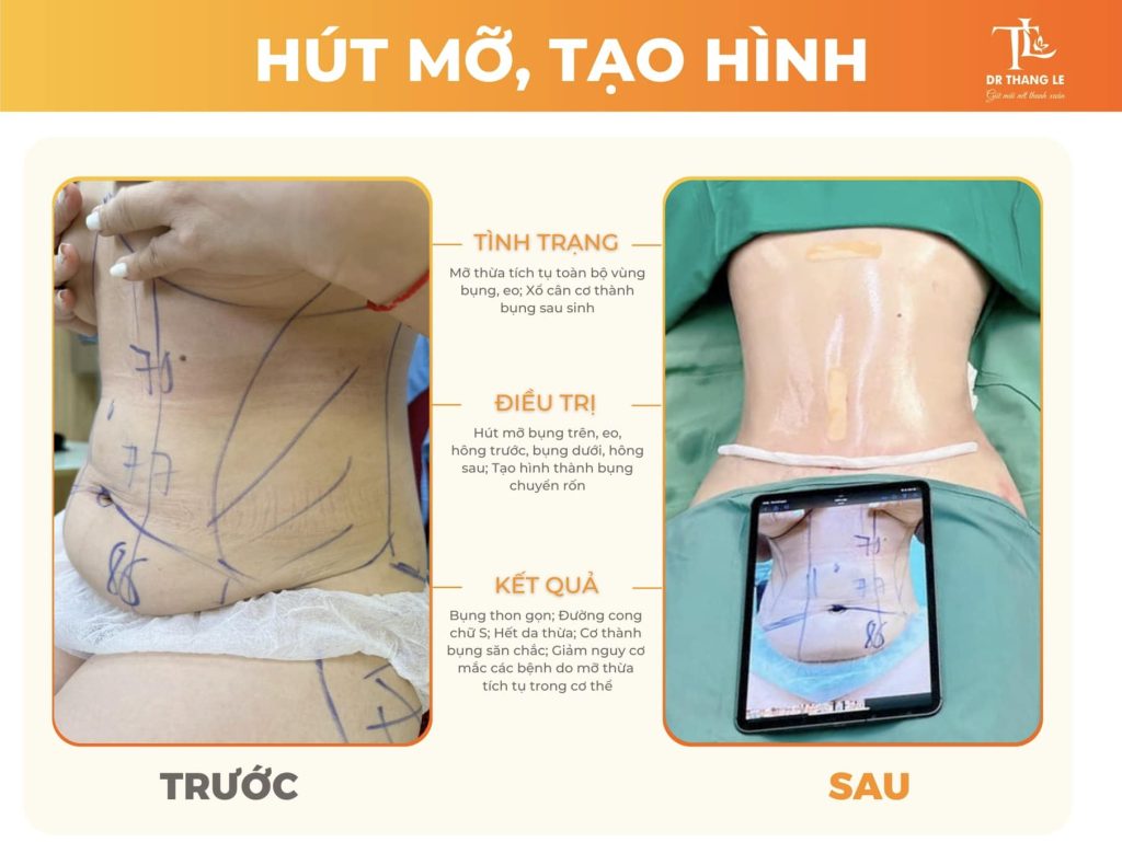 Ca hút mỡ, tạo hình thành bụng tại Bác sĩ Thắng Lê