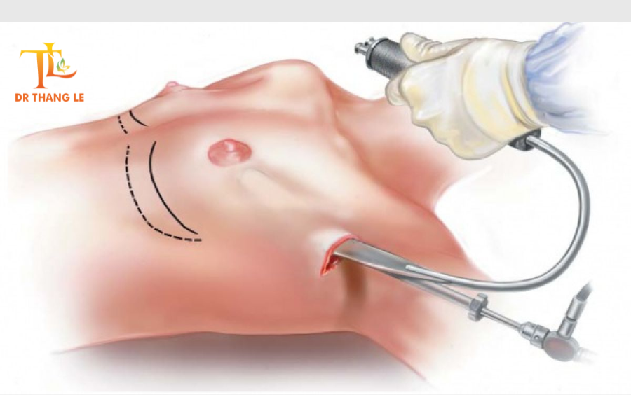 Nâng ngực an toàn, không xâm lấn tại Bác sĩ Thắng Lê