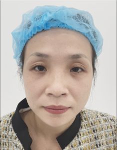 Nhiều nếp mí, da chùng là khuyết điểm dễ nhận thấy của chị M