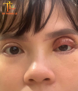 Mí hỏng sẹo chồng chéo, dày dính, biên độ mí “cực khủng” 