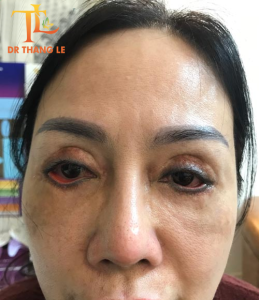 Mí trên/mí dưới bị tổn thương nghiêm trọng