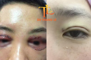 Mí hỏng nặng sau phẫu thuật tới Bs Thắng Lê thăm khám càng sớm càng tốt