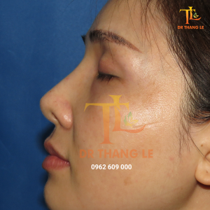 Nâng mũi tại Bác sĩ Thắng Lê để hoàn thiện vẻ đẹp của bạn