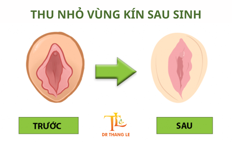 Thu nhỏ âm đạo lấy lại sự tự tin cho chị em sau sinh
