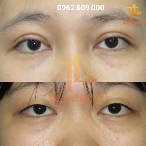 Nếp mí cân bằng, cơ nâng mi hồi phục ngay sau 45 phút phẫu thuật tại Bác sĩ Thắng Lê