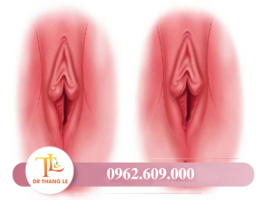 Mũ âm vật là một trong những nơi giúp chị em đạt khoái cảm khi quan hệ vợ chồng