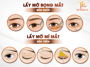 Lấy mỡ bọng mắt trên và bọng mắt dưới tại Bác sĩ Thắng Lê