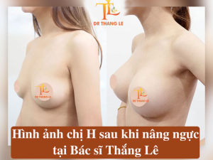 Hình ảnh chị H sau khi thực hiện nâng ngực tại Bác sĩ Thắng Lê