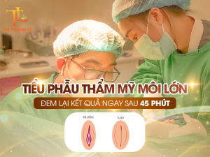 Tiểu phẫu môi lớn được thực hiện bởi Bác sĩ Thắng Lê