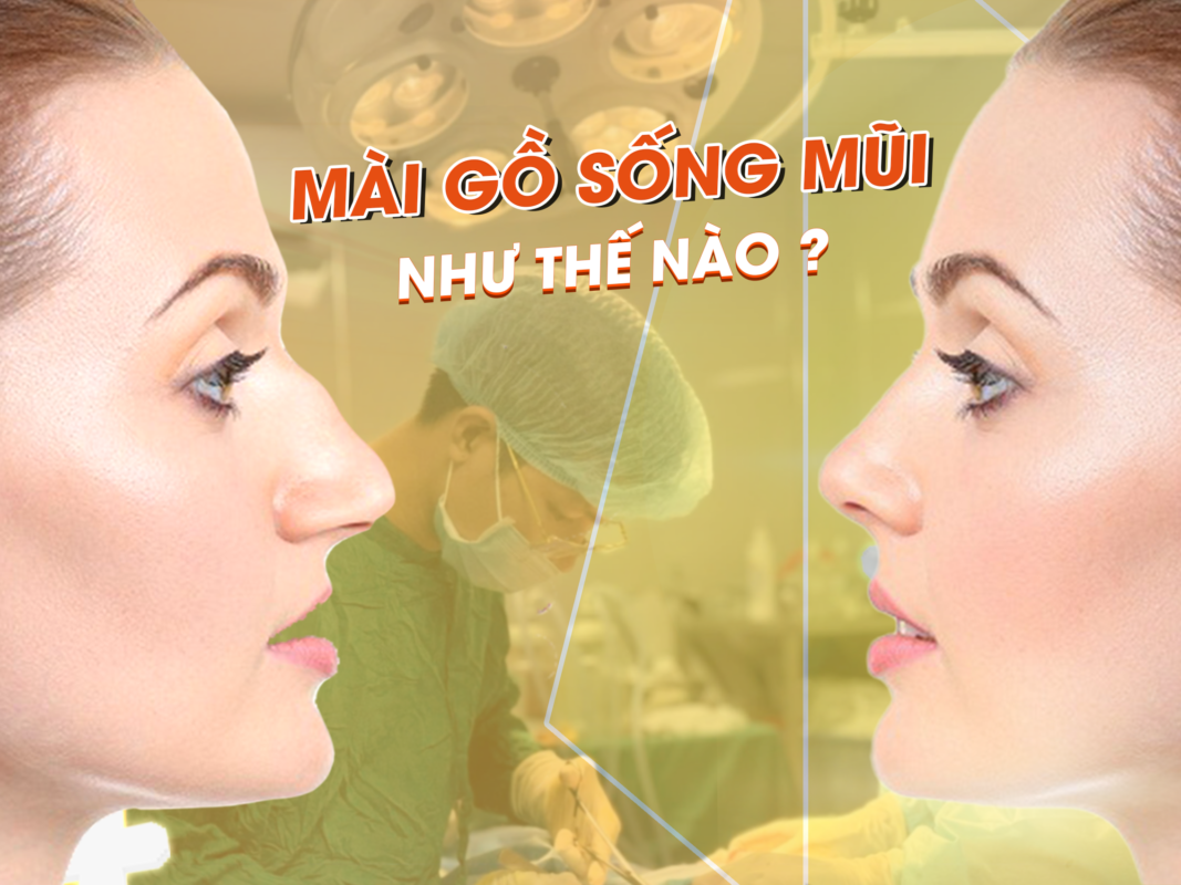 Mài gồ xương sống mũi ở đâu an toàn, chi phí bao nhiêu?