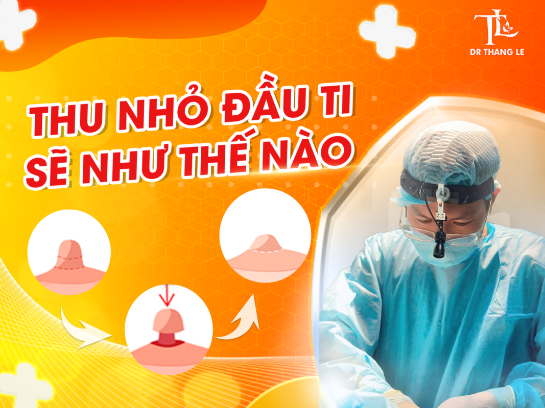 5 lý do chị em nên đi phẫu thuật thu nhỏ đầu ti ngay hôm nay