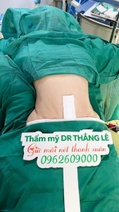 Chị XXX sau ca phẫu thuật hút mỡ bụng tại Bác sĩ Thắng Lê