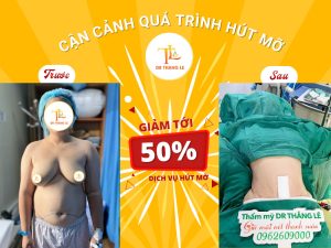 Thẩm mỹ hút mỡ bụng tại Bác sĩ Thắng Lê