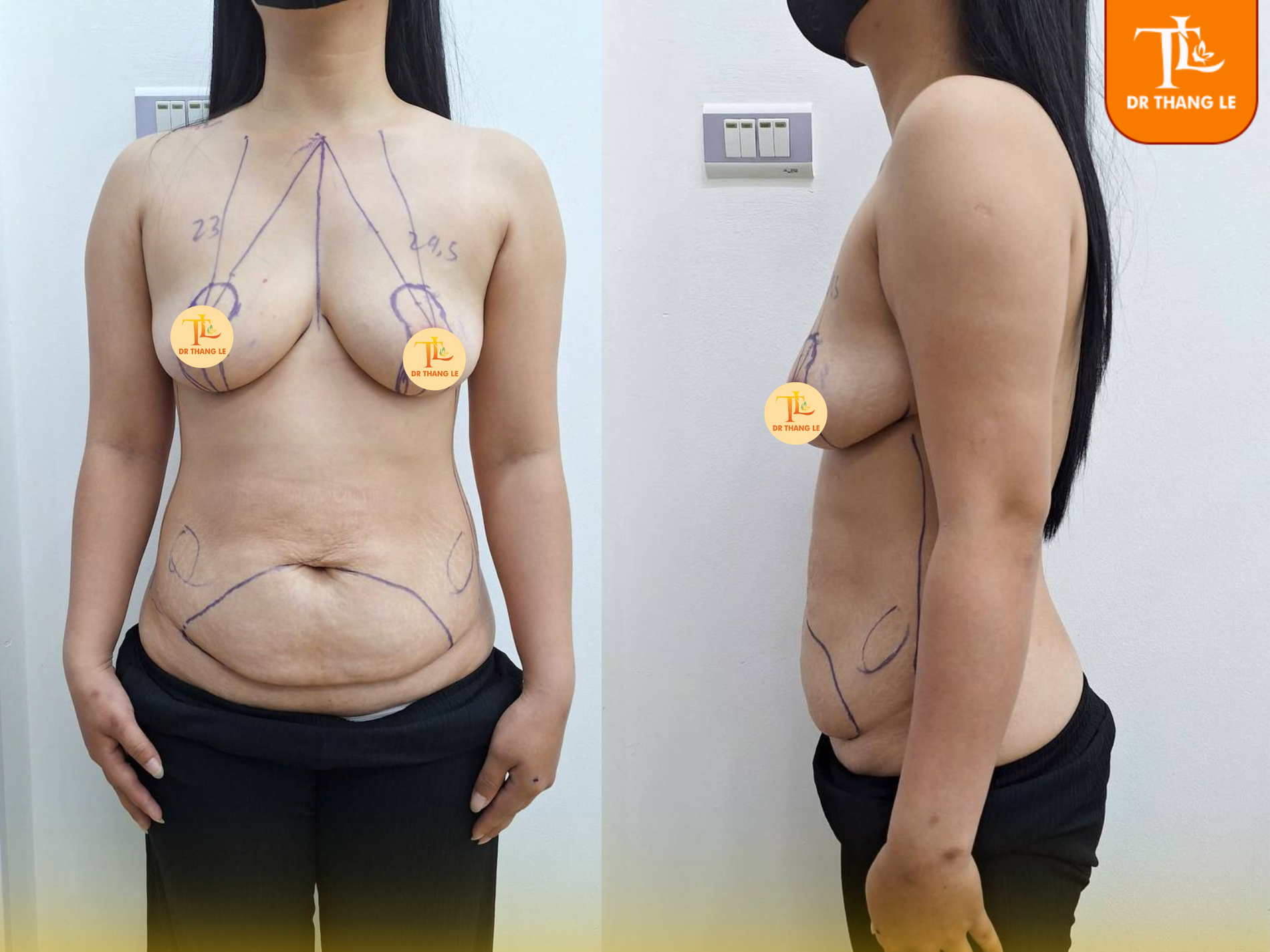 Dấu hiệu nhận biết sa trễ ngực độ 3 và cách khắc phục