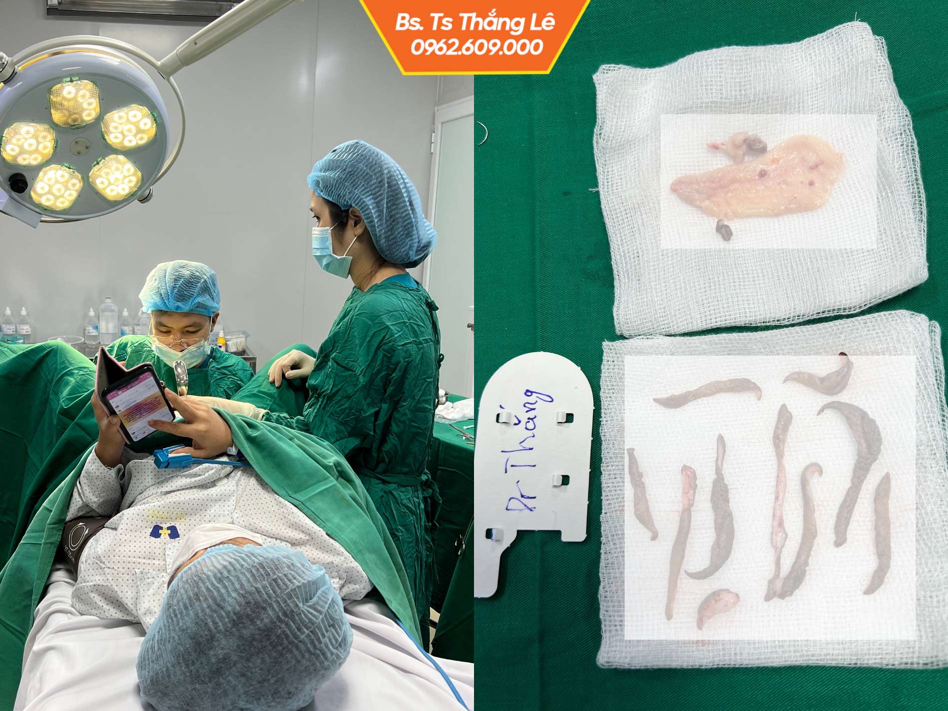 Thực hiện tạo hình môi lớn trong phòng phẫu đạt chuẩn Bộ y tế bởi trực tiếp Thạc sĩ - Bác sĩ Thắng Lê.