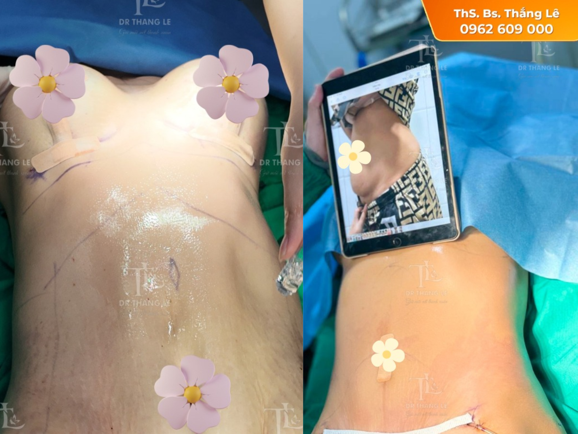 Kết quả của ca tân trang tạo hình thành bụng chuyển rốn tại Thẩm mỹ Dr. Thắng Lê