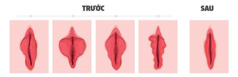 Mô hình trước và sau khi thẩm mỹ cô bé