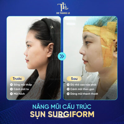 Khách hàng nâng mũi tại Bác sĩ Thắng 