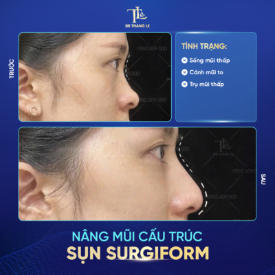 Khách hàng nâng mũi tại Dr Thắng Lê