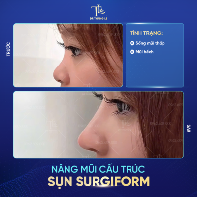 Hình ảnh khách hàng trước và sau nâng mũi tại Dr Thắng Lê