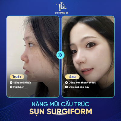 Nâng mũi tại Dr Thắng Lê