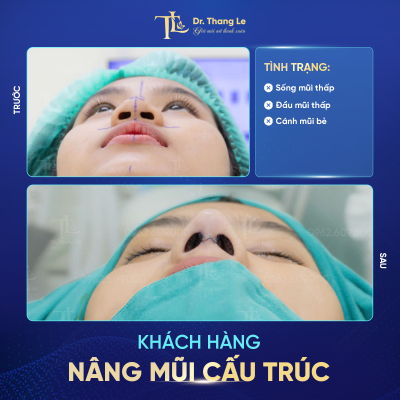 Trước và sau khi nâng mũi tại Dr.Thắng Lê