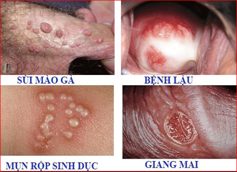Bệnh lây qua đường tình dục