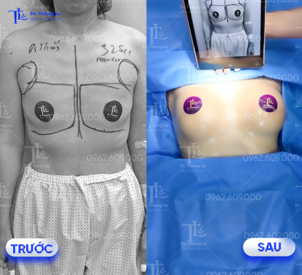 Hình ảnh trước - sau khi nâng ngực tại Dr.Thắng Lê