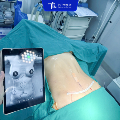 Trước và sau khi hút mỡ eo tại Dr.Thắng Lê